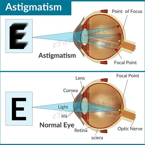 Astigmatism|Causes|Types|Symptoms|Treatment: Lenses, Refractive Surgery