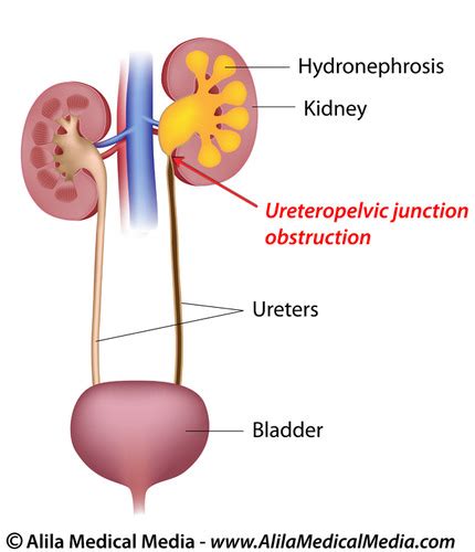 Renal Calculi or Nephrolithiasis Flashcards | Quizlet