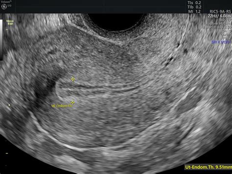 Endometrial Hyperplasia Classification: Improving Diagnoses | Empowered ...