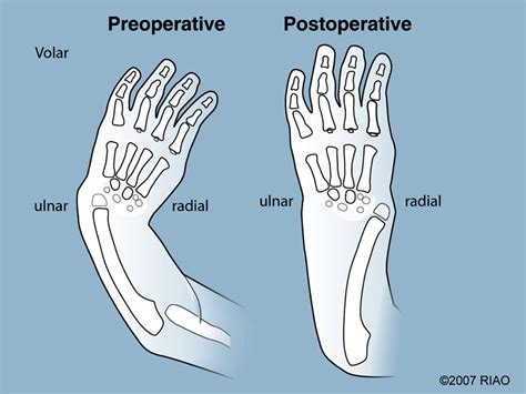 Treatment Strategies - Paley Orthopedic & Spine Institute