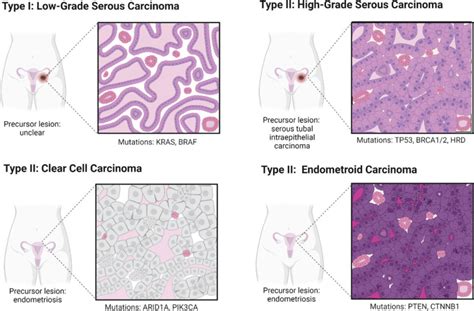 Figure 2, [Common types of epithelial ovarian...]. - Metastasis - NCBI ...