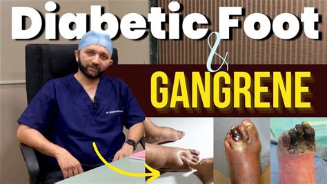 Diabetic Foot & Gangrene: Causes, Complications, and Management | Dr ...