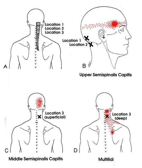 Semispinalis Capitis | The Trigger Point & Referred Pain Guide