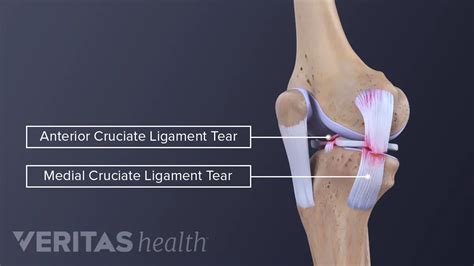 What Are Medial Collateral Ligament (MCL) Tears How To, 58% OFF