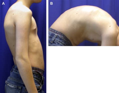 Scheuermann's Kyphosis - Neurosurgery Clinics