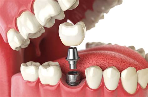 How is a Crown Attached to a Dental Implant? | Etobicoke