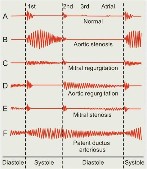 What Does Heart Murmur Sound Like