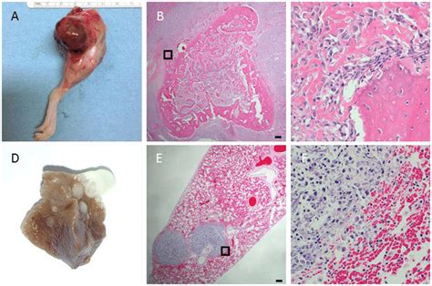 Histology Of Osteosarcoma