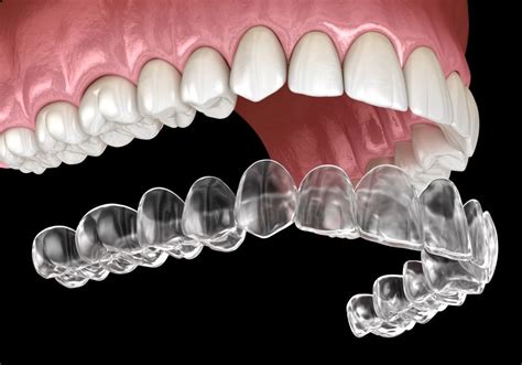 Invisalign Maintenance Best Practices | Dr. Alex Midtown NYC Cosmetic ...