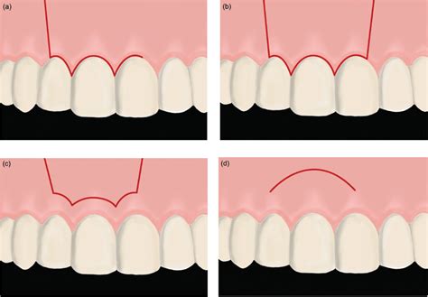 Surgical Endodontics | Pocket Dentistry