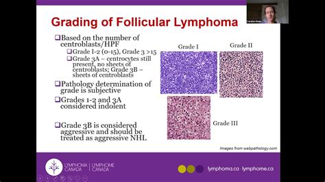 Follicular Lymphoma and other Indolent Lymphomas - YouTube