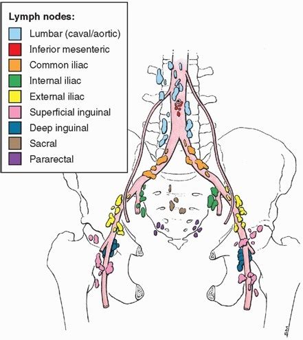 External Iliac Node