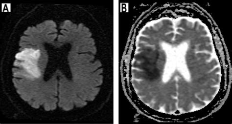 Imaging in Acute Stroke - The Western Journal of Emergency Medicine