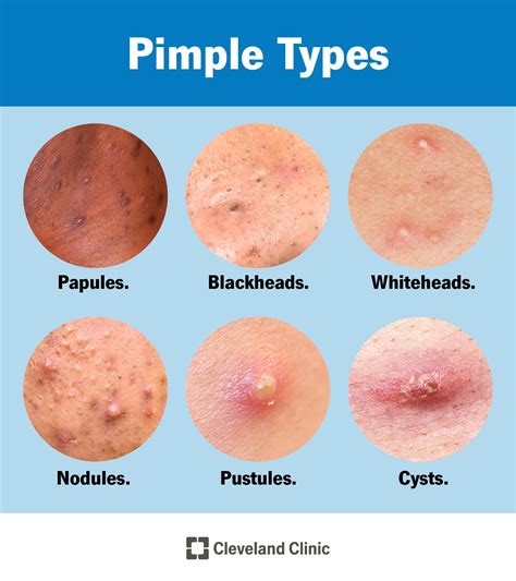 Pimples: Causes vs. Acne, Types & Treatment