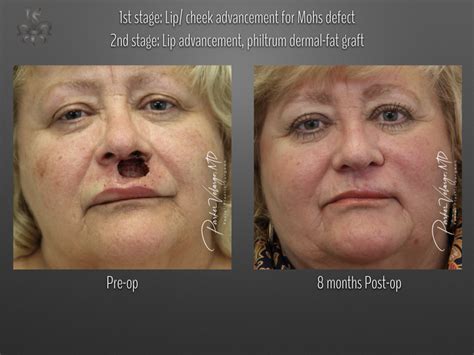 Mohs Surgery | New Orleans | New Orleans Center for Aesthetic and ...