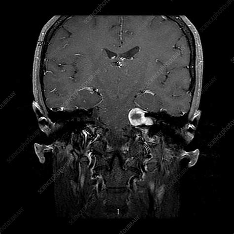 Vestibular Schwannoma, MRI - Stock Image - C039/4309 - Science Photo ...