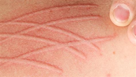 Dermatographia: Symptoms, Treatment, and More