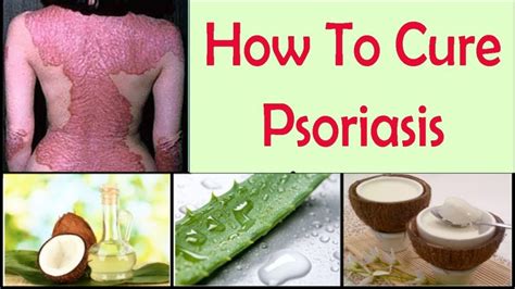 Psoriasis: 17 Natural Home Remedies