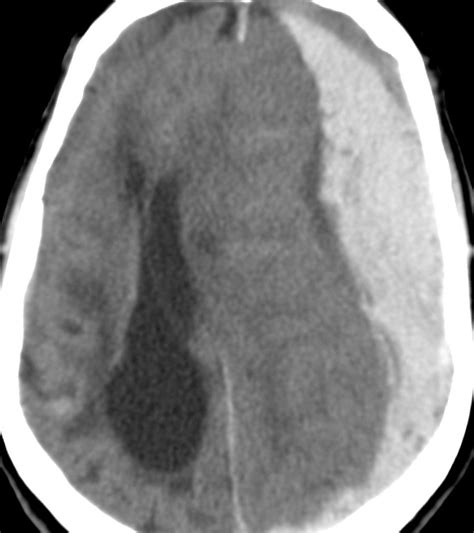 Subdural Hematoma Brain