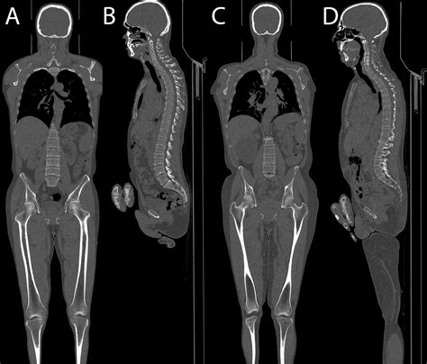 Frontiers | Ultra-Low-Dose Whole-Body Computed Tomography Protocol ...