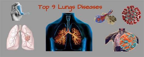 Top 9 Respiratory Disease- Causes, Signs and Symptoms | by Romit ...