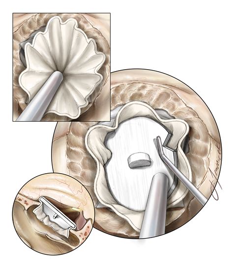 Craniopharyngioma | The Neurosurgical Atlas, by Aaron Cohen-Gadol, M.D.