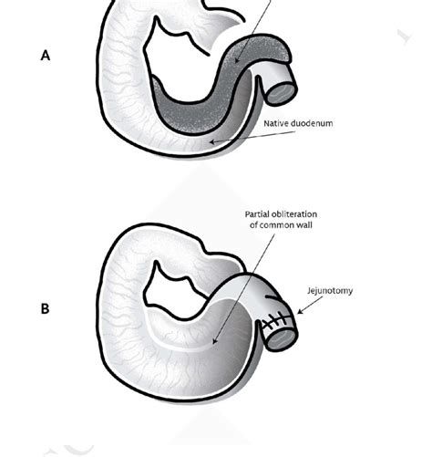 Schematic representation of the long tubular duplication cyst and ...