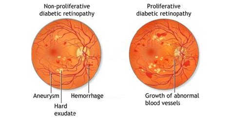 Non Proliferative Diabetic Retinopathy