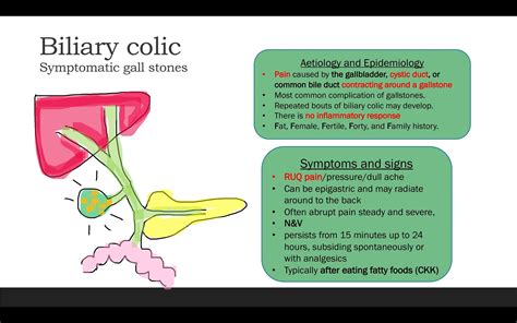 Gall stones and Biliary colic | Apple Bite teach #2 | By Lifestyle ...