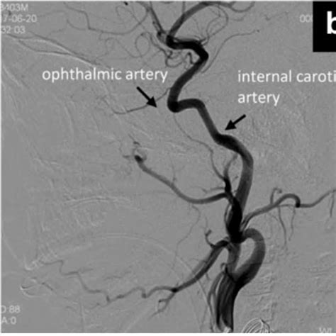 The technique of intra-arterial chemotherapy (IAC) treatment. (A): An ...