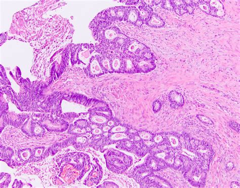 Adenocarcinoma Colon Histology