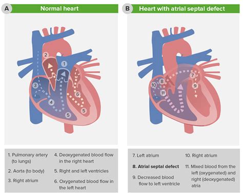 Atrial Septal Defect Anatomy