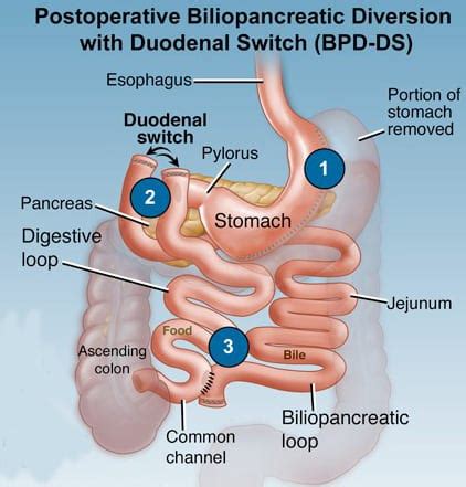 Duodenal Switch | Foothills Weight Loss