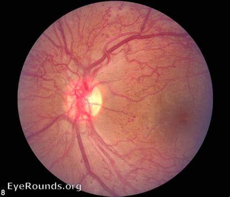 Retinal neovascularization; Neovascularization, Retinal