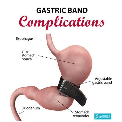 Gastric Banding (Lap-Band) Surgery Risks, Complications