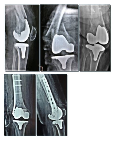 KNEE PERIPROSTHETIC FRACTURES IN THE ELDERLY: CURRENT CONCEPT ...