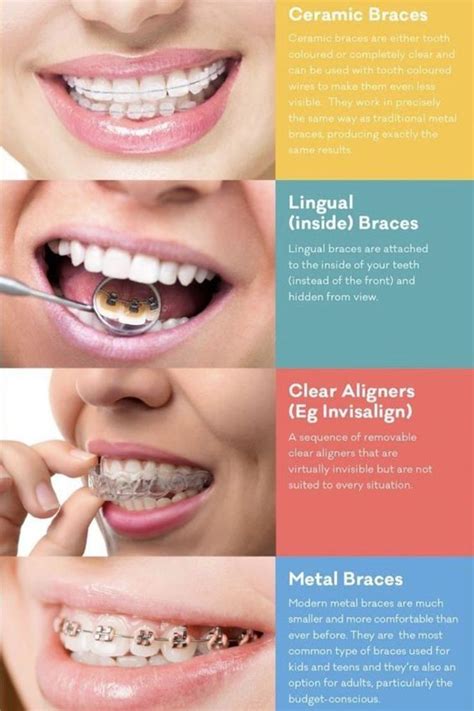 Pin by Jessica Arévalo on Braces Types | Straighten teeth without ...