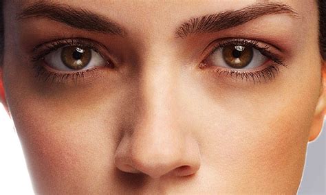 5 Causes Of Dark Circles Under Your Eyes That You Should Know About!