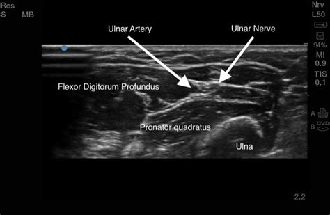 Median Nerve Ultrasound