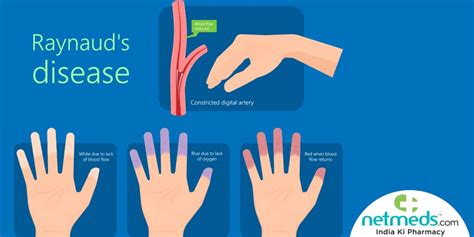 Syndrome De Raynaud Traitement Causes Diagnostic De Quoi S Agit Il ...