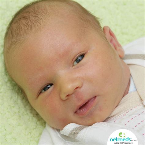 New-born Jaundice: Risk Factors, Symptoms And Treatment