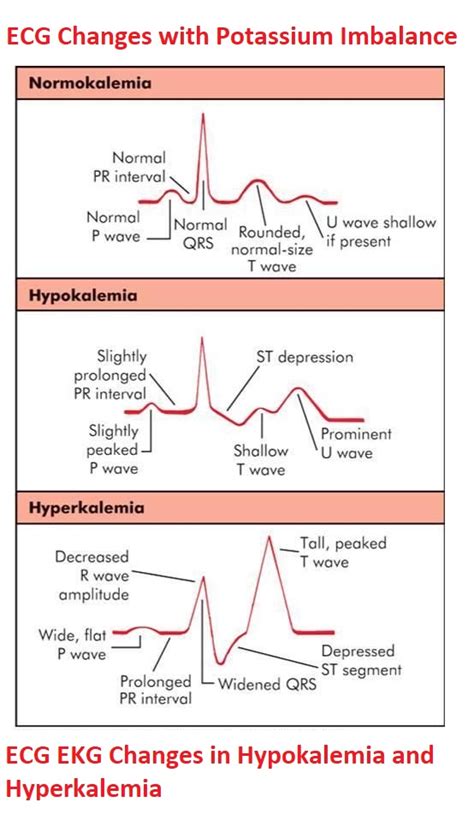 ECG/EKG Changes in Hypokalemia and Hyperkalemia - NCLEX Quiz