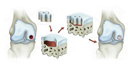 Chondral Lesions and Osteochondral Defects