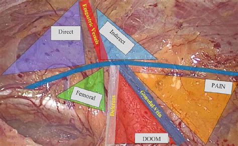 Transabdominal Preperitoneal (TAPP) Inguinal Hernia Repair | IntechOpen