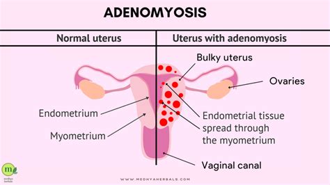 Adenomyosis Diet: The Best Foods to Eat for Fertility