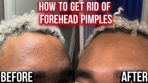 How to Get rid of Forehead Pimples | Proven Method in 3 days Steps ...