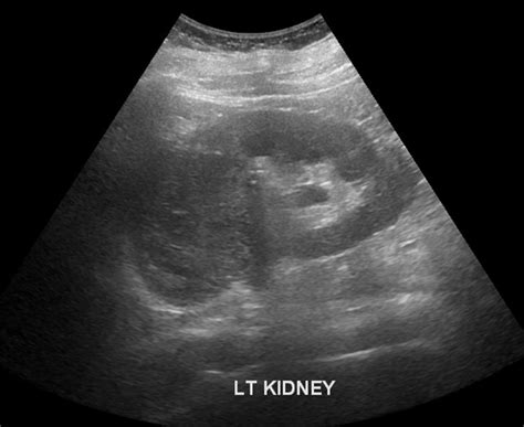 Kidney Tumor Ultrasound