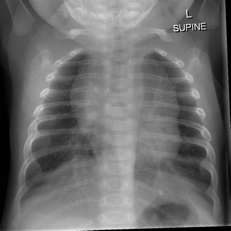 Chest X Ray Pneumonia Vs Bronchitis