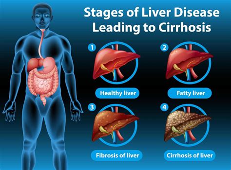 Liver Cirrhosis Stages