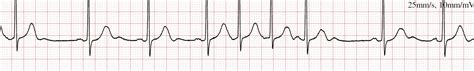 Ectopic Beats Treatment In London | Ectopic Heartbeat | Dr Boon Lim